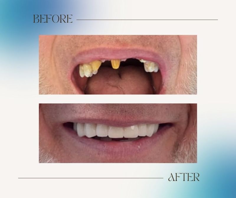 A Same-Day Smile Transformation with Zirconia Crowns at Premier Smiles