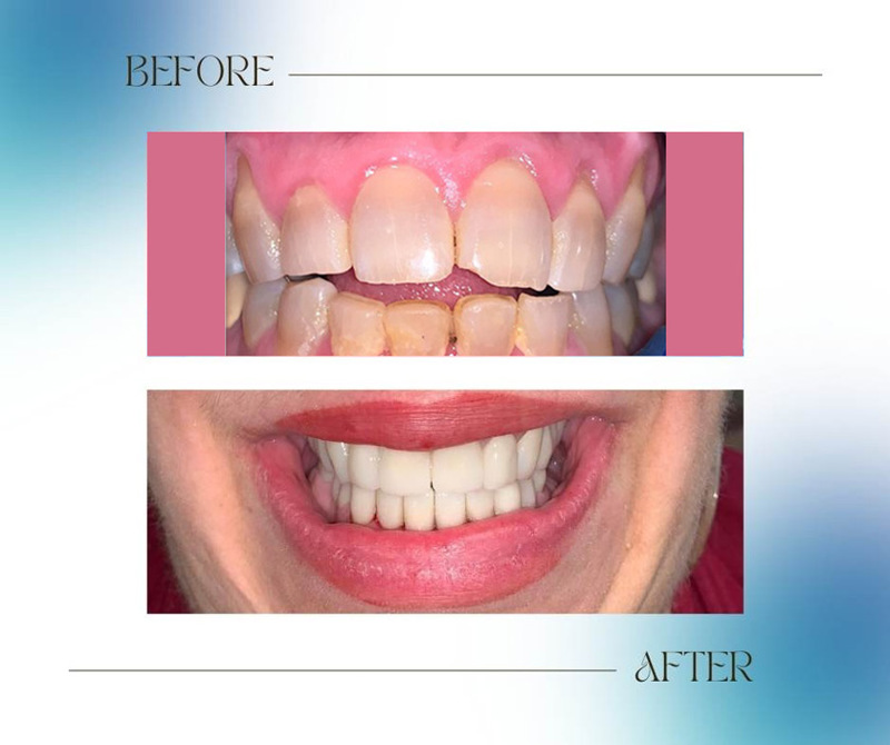 Transforming a patient’s Smile with Dental crowns at Premier Smiles – Case study