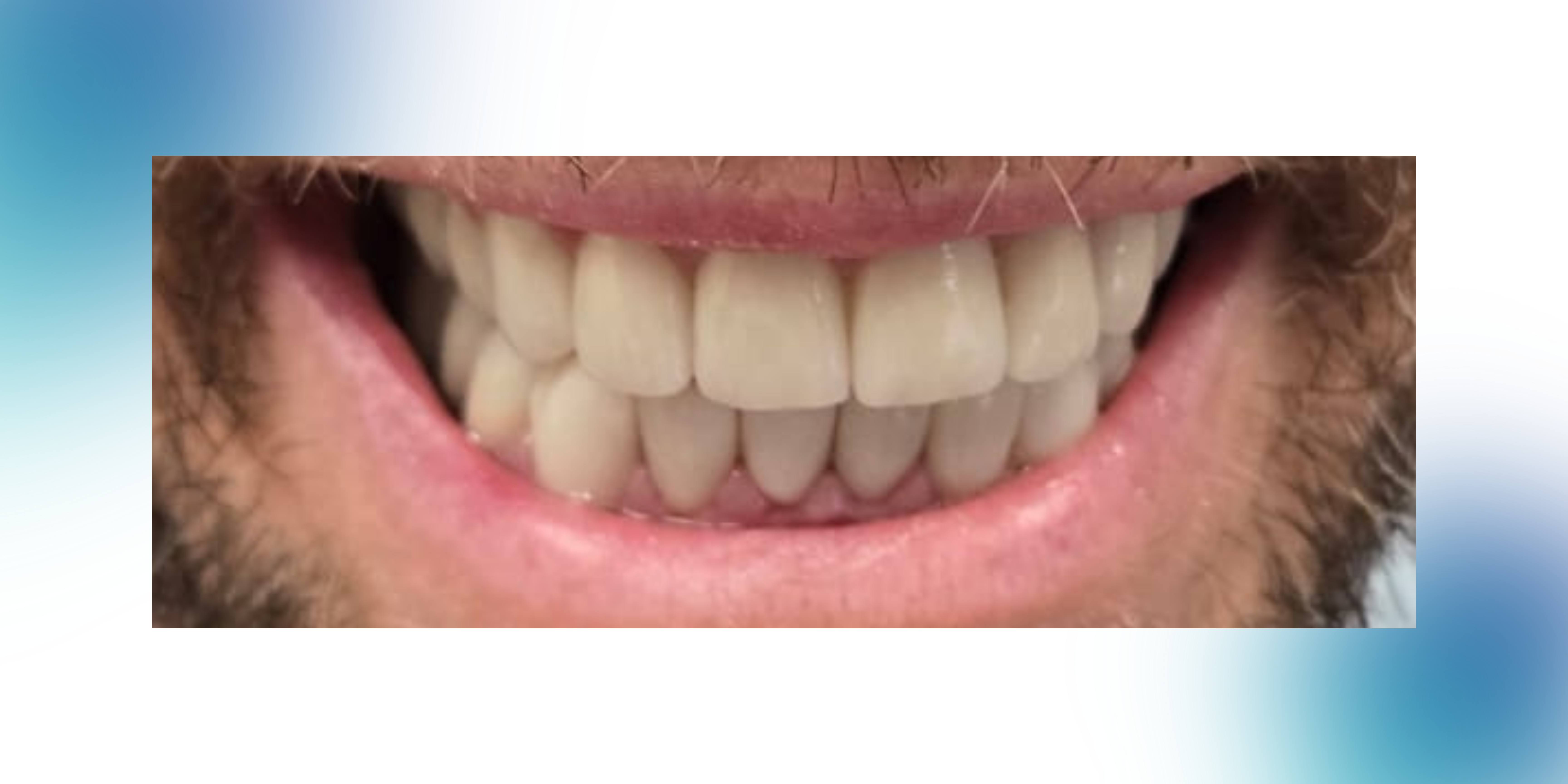 A Same-Day Smile Transformation with Zirconia Crowns at Premier Smiles