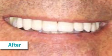 Patient Photos Depicting After