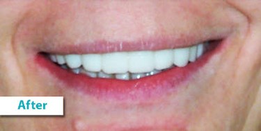 Patient Photos Depicting After