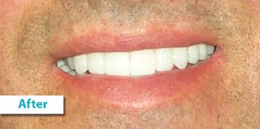 Patient Photos Depicting After