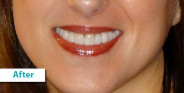 Patient Photos Depicting After