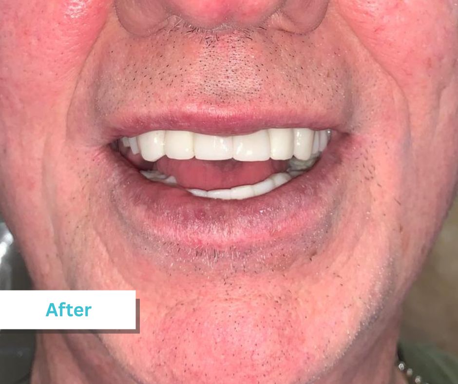 Patient Photos Depicting After