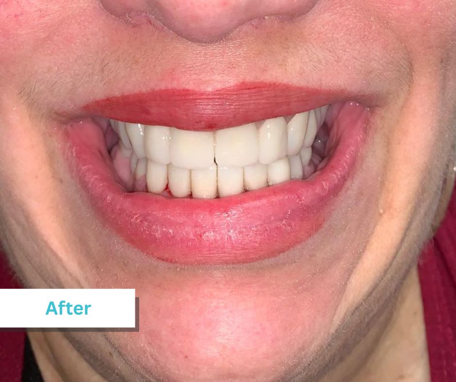 Patient Photos Depicting After