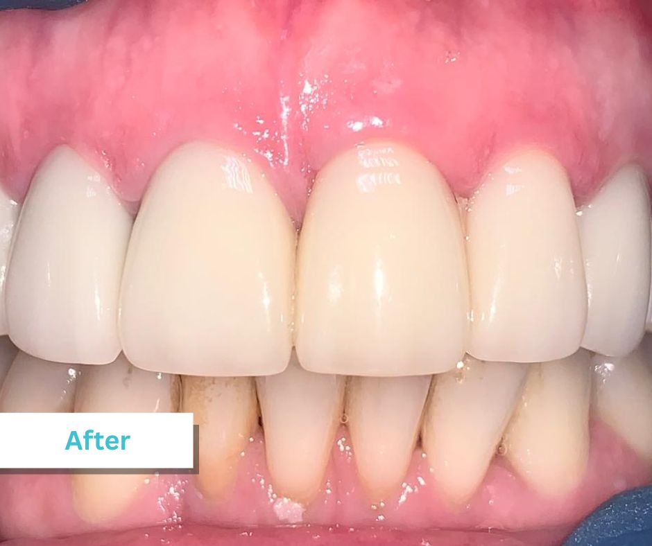 Patient Photos Depicting After