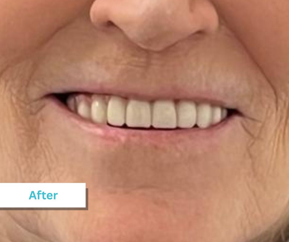 Patient Photos Depicting After