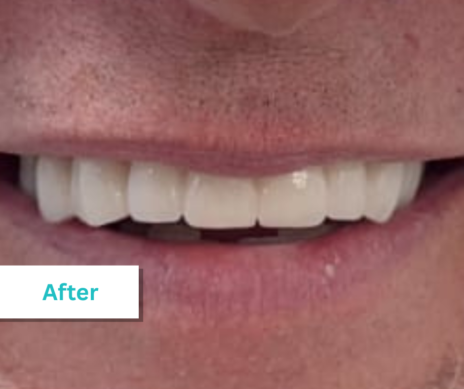 Patient Photos Depicting After