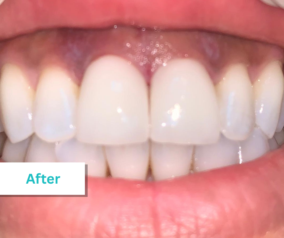 Patient Photos Depicting After